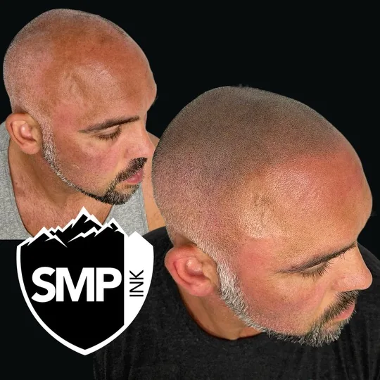 Scalp Micropigmentation in Seattle portfolio work